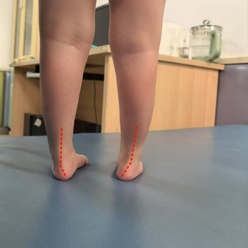 Understanding Varus Feet in Children: Causes, Risks, and Effective Treatments