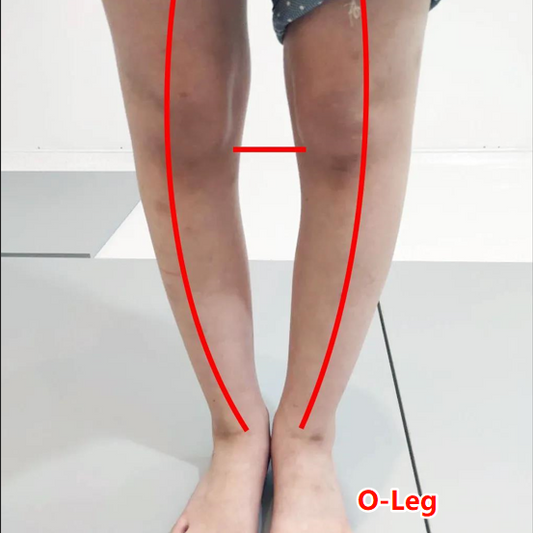 Understanding O-Shaped and X-Shaped Legs in Children: Causes, Risks, and Effective Treatments